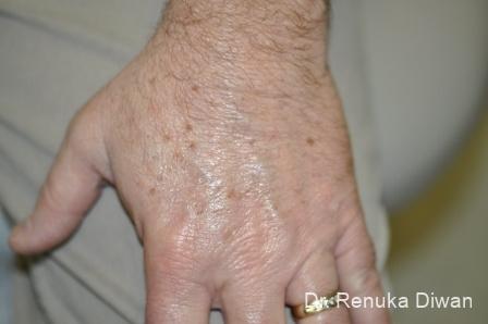 Lasers-for-brown-spots-for-men: Patient 1 - Before 