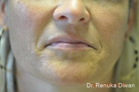 Lips And Mouth: Patient 18 - Before 1