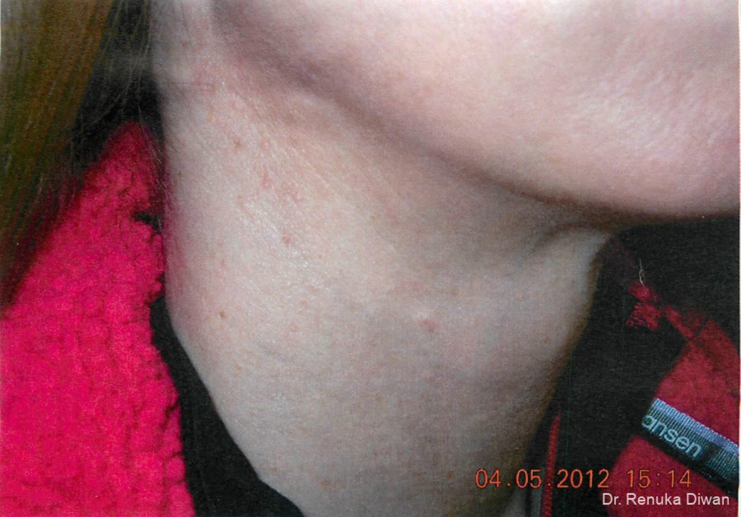 Neck Creases: Patient 4 - After  
