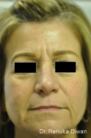 Non-Surgical Facelift: Patient 1 - Before 
