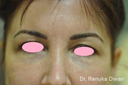 Blepharoplasty: Patient 2 - Before 
