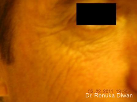 Botox-cosmetic-for-men: Patient 6 - Before 