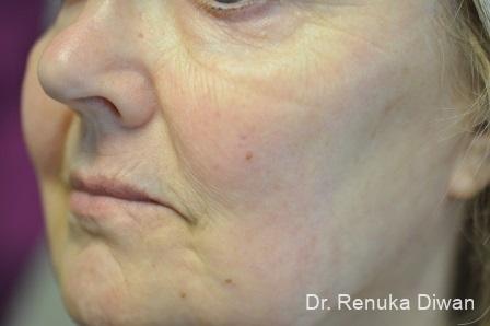 Laser Skin Resurfacing: Patient 8 - After  