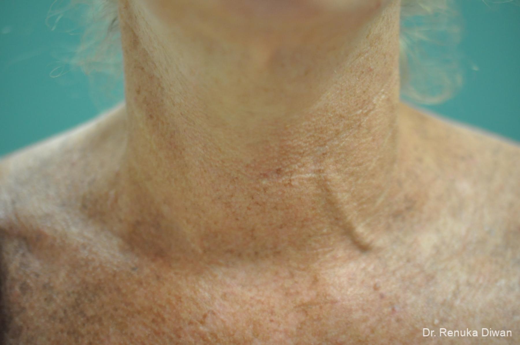 Skin Tightening: Patient 11 - After 1