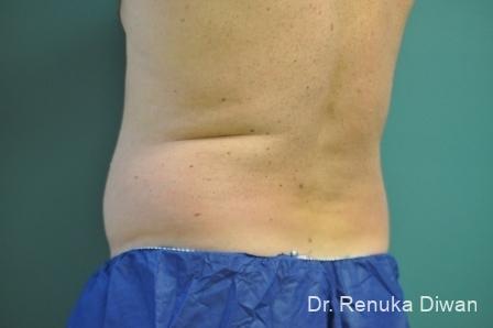 Coolsculpting-for-men: Patient 2 - Before 