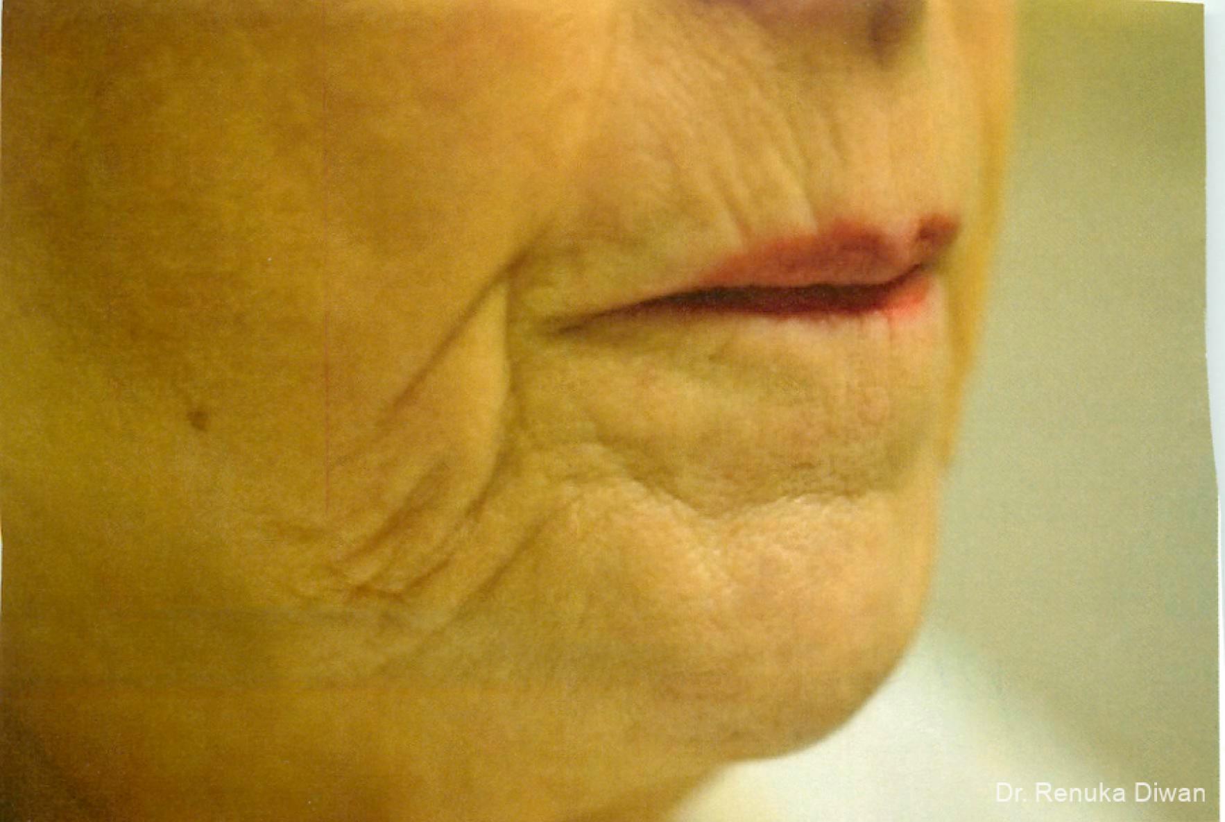 Marionette Lines: Patient 6 - Before 1