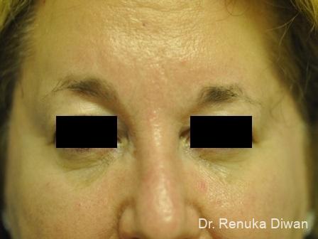 BOTOX® Cosmetic: Patient 6 - After 1