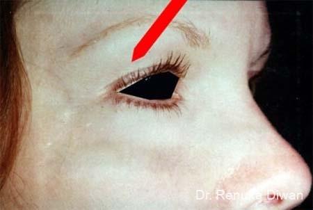 Blepharoplasty: Patient 5 - Before 