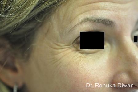BOTOX® Cosmetic: Patient 19 - Before 1