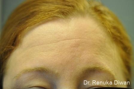Forehead Creases: Patient 6 - Before 1