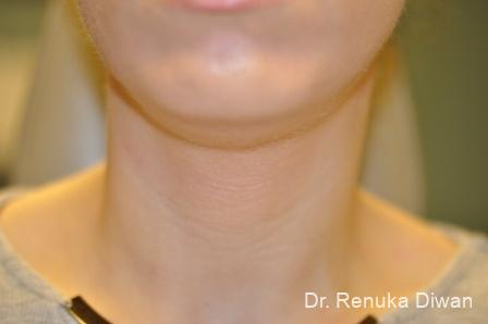 Kybella: Patient 2 - Before 