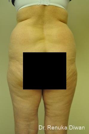 Liposuction: Patient 13 - Before 1