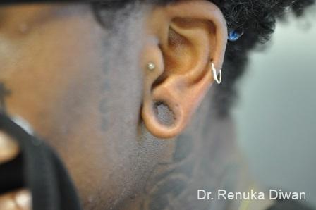 Earlobe Surgery: Patient 8 - Before 