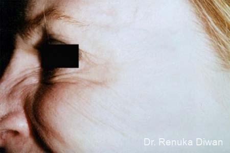 BOTOX® Cosmetic: Patient 19 - After Image