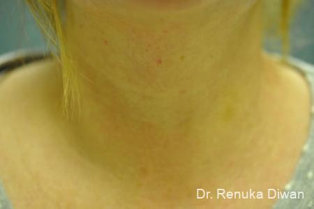 Neck Creases: Patient 1 - After  
