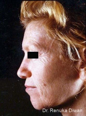 Chemical Peel: Patient 1 - Before 