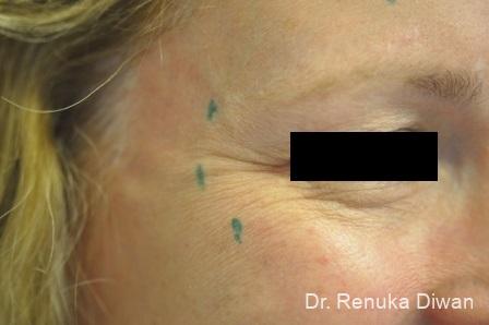 BOTOX® Cosmetic: Patient 24 - Before Image