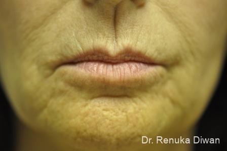 Lips And Mouth: Patient 14 - Before 1