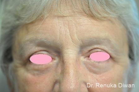 Blepharoplasty: Patient 12 - After 1