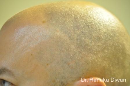 Laser Treatment Of Angiomas: Patient 1 - After