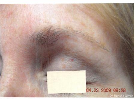 Laser For Veins And Redness: Patient 3 - Before 