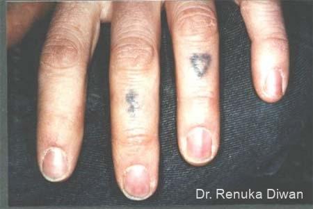 Tattoo Removal: Patient 2 - Before 1
