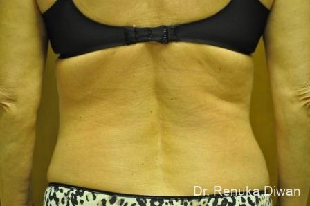 Liposuction: Patient 5 - After  