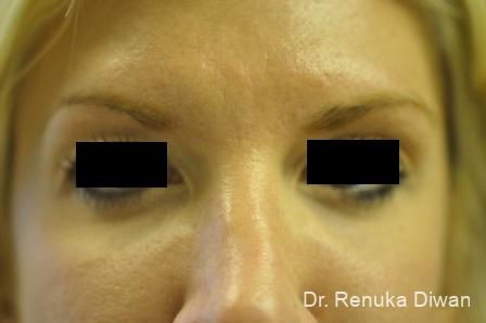 BOTOX® Cosmetic: Patient 2 - After  