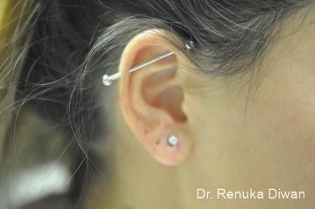 Earlobe Surgery: Patient 6 - After 2