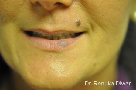Laser For Veins And Redness: Patient 20 - Before 1
