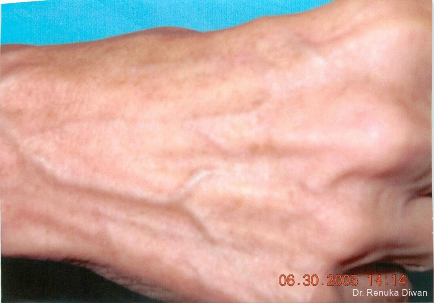 Lasers For Brown Spots: Patient 7 - After 1