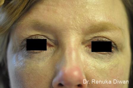 Blepharoplasty: Patient 8 - Before 