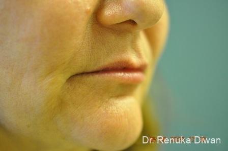 Lips And Mouth: Patient 17 - After 1
