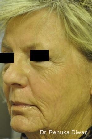 Laser Skin Resurfacing: Patient 6 - After 1