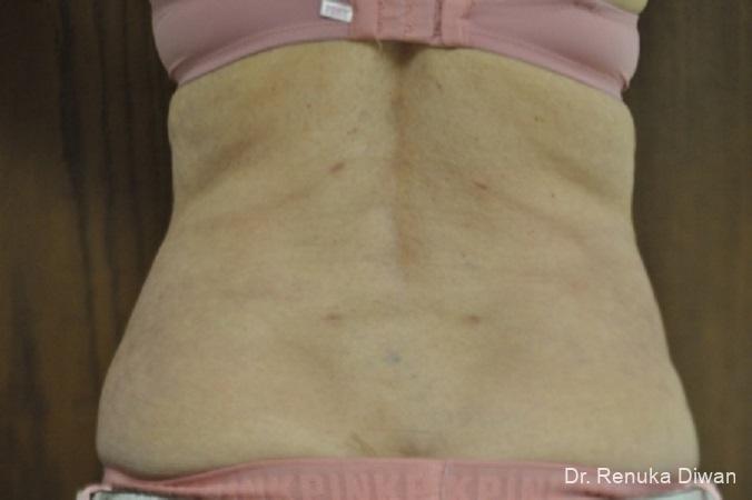 Liposuction: Patient 7 - After  