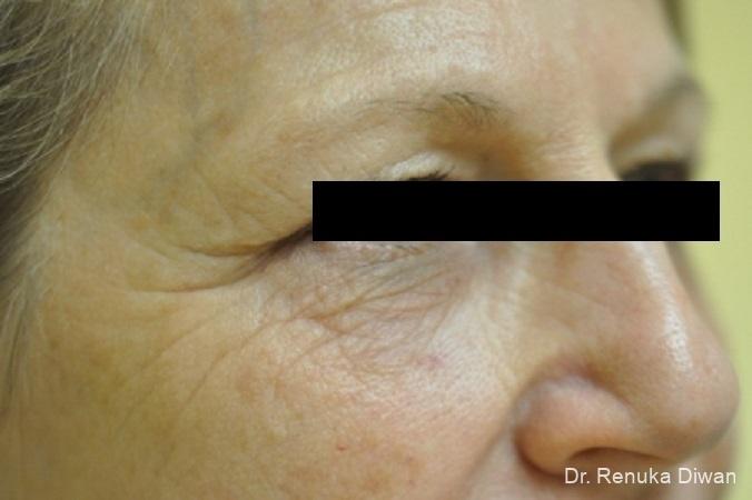 Microneedling: Patient 1 - After 2