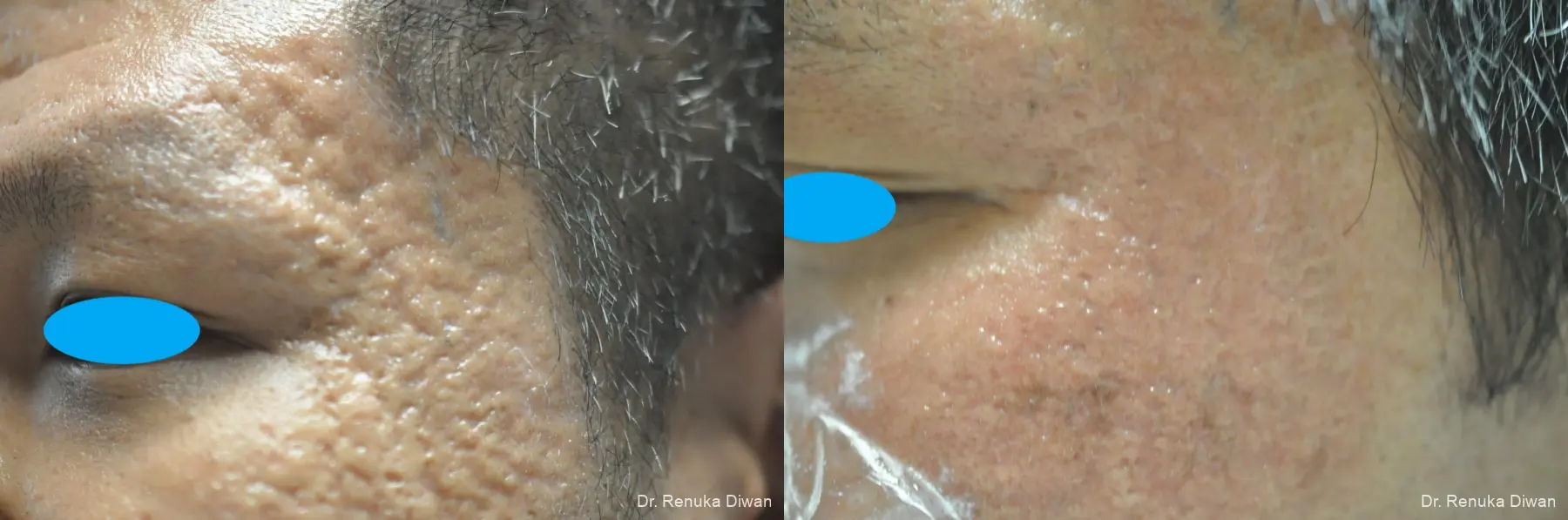Acne Scars: Patient 6 - Before and After  