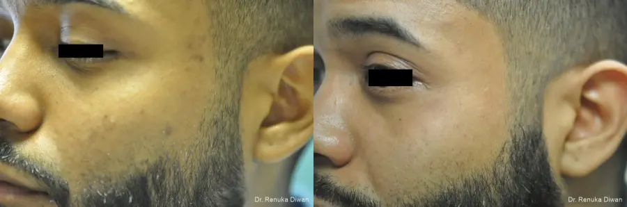 Acne Scars: Patient 5 - Before and After 2