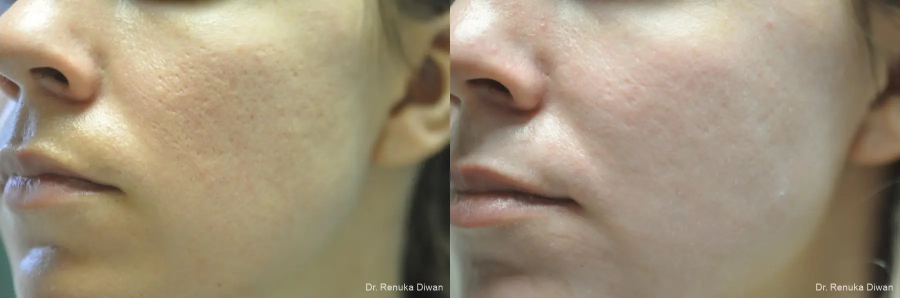 Acne Scars: Patient 1 - Before and After 1