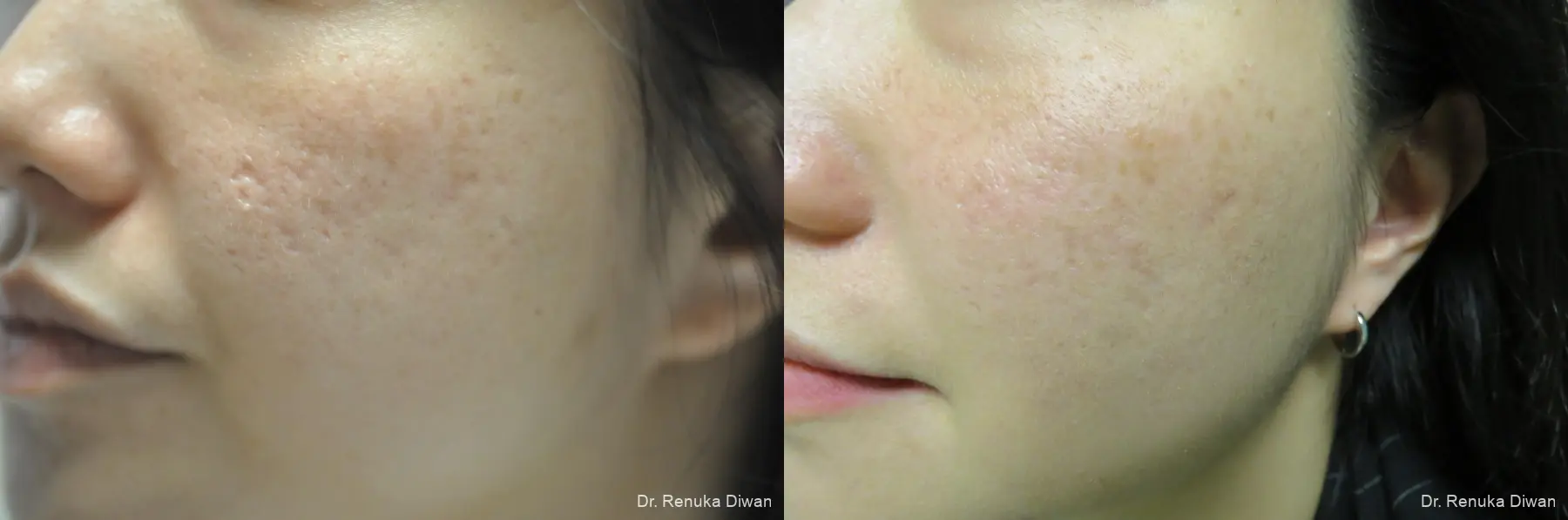 Acne Scars: Patient 9 - Before and After 1