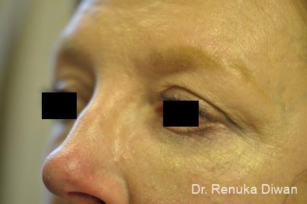 Blepharoplasty: Patient 8 - Before and After 2
