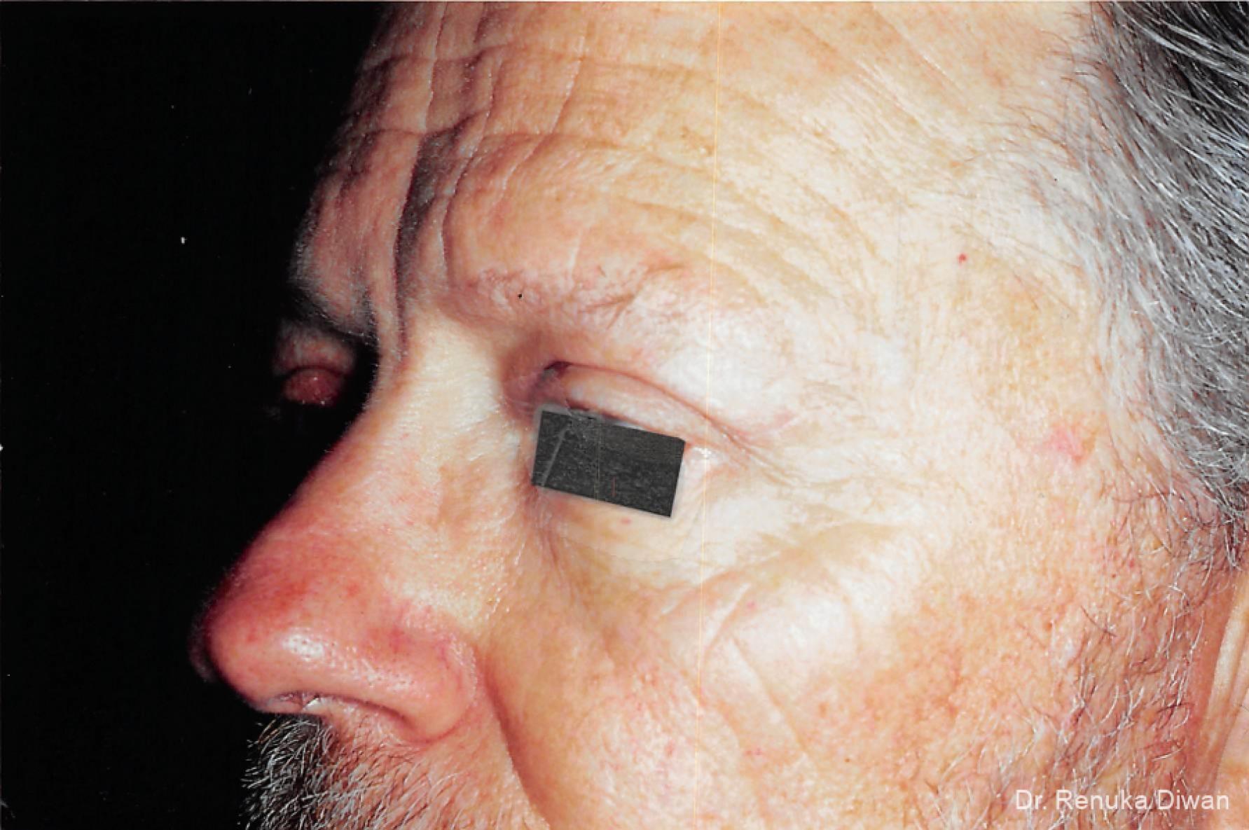 Blepharoplasty For Men: Patient 1 - After 1