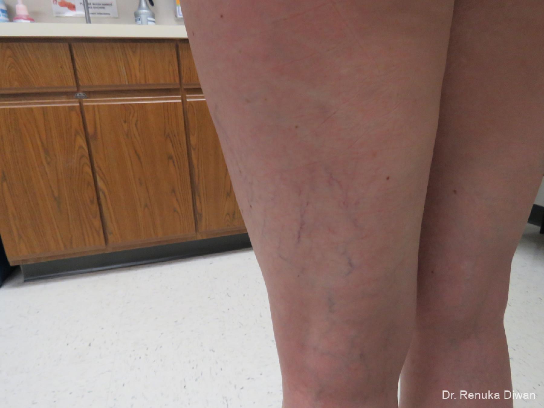 Veins On Legs: Patient 5 - Before 