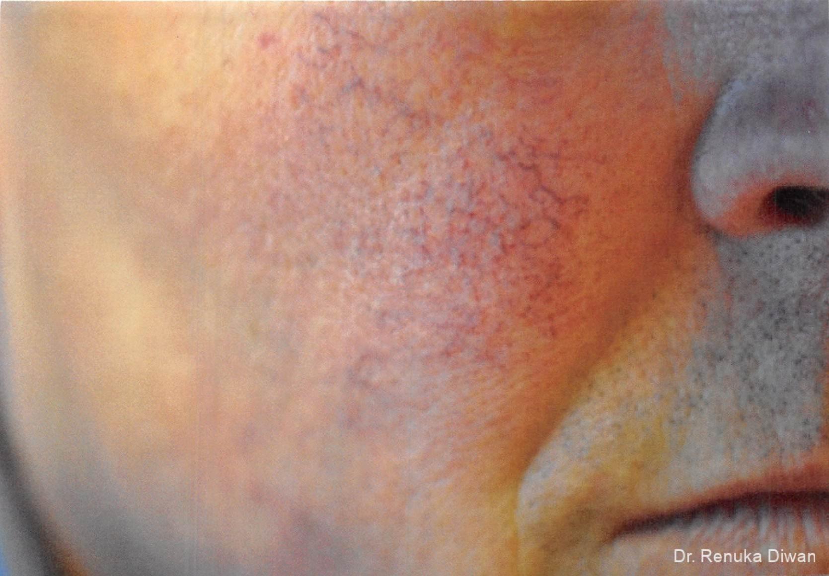 Laser-for-veins-and-redness-for-men: Patient 6 - Before 