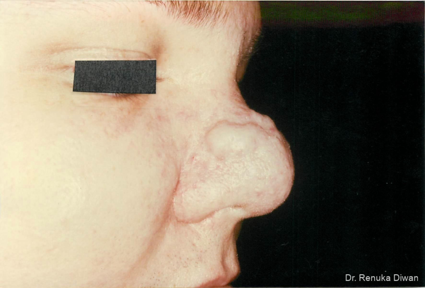 Lasers For Rhinophyma: Patient 3 - Before 