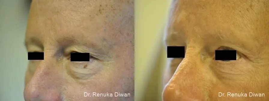 Blepharoplasty-for-men: Patient 2 - Before and After  