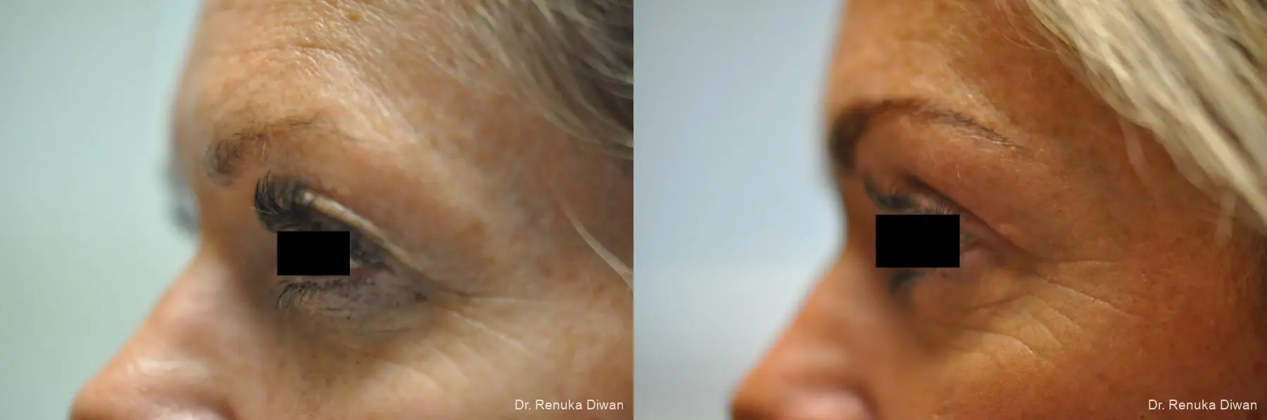 Blepharoplasty: Patient 1 - Before and After 1