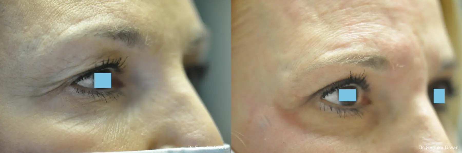 Blepharoplasty: Patient 7 - Before and After 4