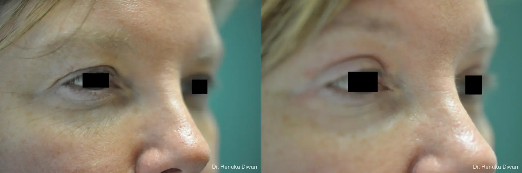 Blepharoplasty: Patient 2 - Before and After  