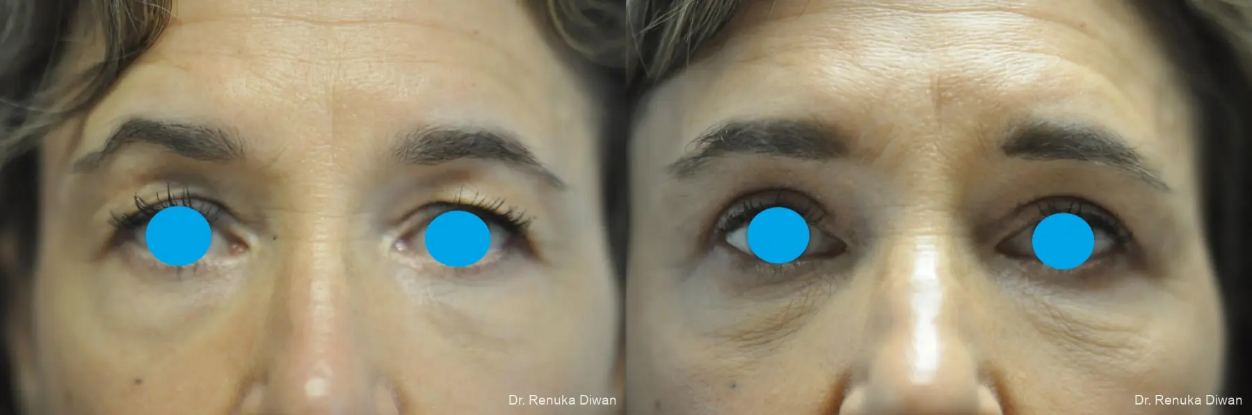 Blepharoplasty: Patient 22 - Before and After 3